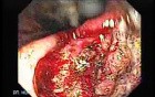 Adenocarcinoma of the Antrum (5 of 5)