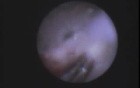 Resorption Of Root