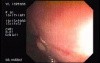 Tubulo - Villous Adenoma - Endoscopy (25 of 28)