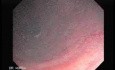 Tubulo - Villous Rectal Adenoma - Endoscopy (21 of 35)