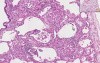 Sarcoidosis