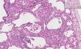 Sarcoidosis