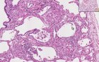 Sarcoidosis