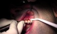 Tunneling Technique - Gingival Grafting #11-12