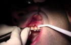 Tunneling Technique - Gingival Grafting #11-12