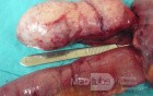 Appendiceal Carcinoid tumor (3 of 3)