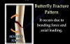 Working Bones Fractures, Types And Mechanisms 