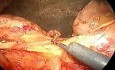 Pancreaticoduodenoctomy - part 1/3