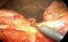 Pancreaticoduodenoctomy - part 1/3