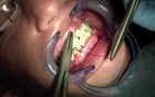 Jaw Fracture - Fixating Mandible And Maxilla