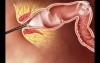 Colonoscopy