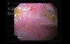 Endoscopic View Of Upper Gastrointestinal Hemorrhage- Forrest II