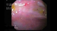 Endoscopic View Of Upper Gastrointestinal Hemorrhage- Forrest II