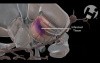 Incorrect Aneurysm Clipping