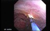 Upper Gastrointestinal Bleeding - Status Post Coagulation