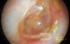 Middle Ear Elevation with Air Bubble