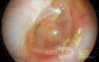 Middle Ear Elevation with Air Bubble