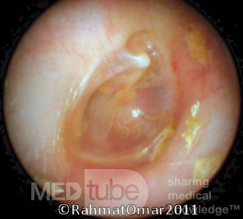 Middle Ear Elevation with Air Bubble