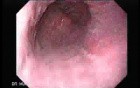 Barrett's Esophagus of long segment (4 of 11)