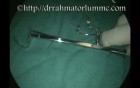 Uvulopalatal Retraction Device for Exposure of Nasopharynx