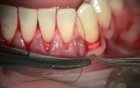 Biomaterials - Best Way To Cover Gingival Recession
