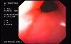 Barret´s Esophagus long segment (2 of 4)