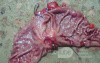 Diffuse Adenocarcinoma with signet ring cells (13 of 18)