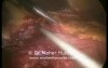Total gastrectomy with D2 Resection - Laparoscopic Approach