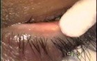 Meibomian gland dysfunktion - surgery with use the Fugo Blade