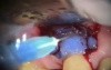 Reparation Of Root Restoration - Periodontal Microsurgery