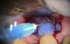 Periodontal Microsurgery Root Resorption Repair