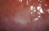 Colposcopy - cervicitis, symptom 'dew drops'