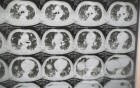 Chest Metastasis Due To Renal Cell Carcinoma 1