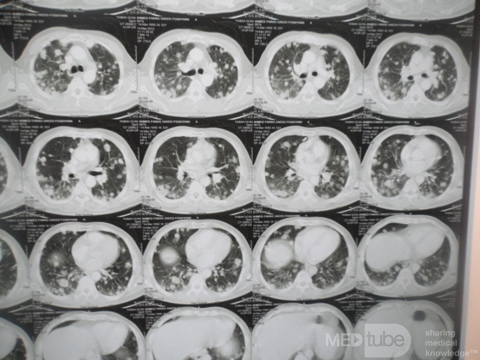 Chest Metastasis Due To Renal Cell Carcinoma 1