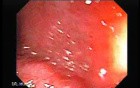 Crohn´s Colitis (2 of 3)