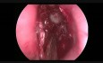 Endoscopic Transnasal Removal of Frontal Sinus Osteoma - Darf IIb