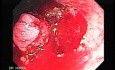 Endoscopic Resection of Giant Tubulo-Villous of the rectum (10 of 35)