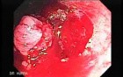 Endoscopic Resection of Giant Tubulo-Villous of the rectum (10 of 35)