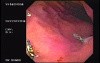 Intraluminal Endoscopic Suturing - Presence of Two Nodules as a Result of Plication