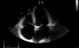 Chronic Kidney Disease as a Main Reason of Aorto-Mitral Valve Calcification