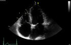 Chronic Kidney Disease as a Main Reason of Aorto-Mitral Valve Calcification