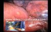 Uniportal VAT Left Upper Lobectomy Lung Cancer