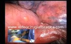 Uniportal VAT Left Upper Lobectomy Lung Cancer