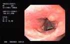 Small papilomas of the larynx