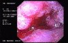 Gastric Adenocarcinoma - Patient With A LargeWeight Loss