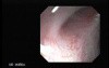 Choledocoduodenostomy and The Sump Syndrome (8 of 10)