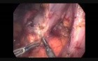 Laparoscopic Resection Of A Duodenal GIST