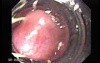 Long Standing Alcohol Abuse - Ligation of Esophageal Varix