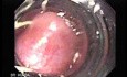 Long Standing Alcohol Abuse - Ligation of Esophageal Varix