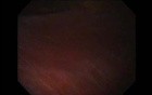 Gastrointestinal Stromal Tumor - GIST (30 of 65)
